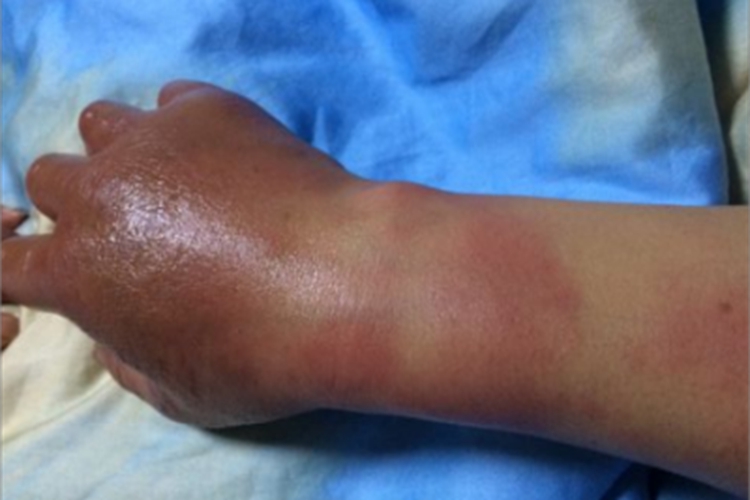 蜂窝织炎手部症状图