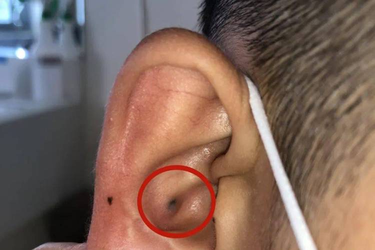 耳朵三角窝毛囊炎图