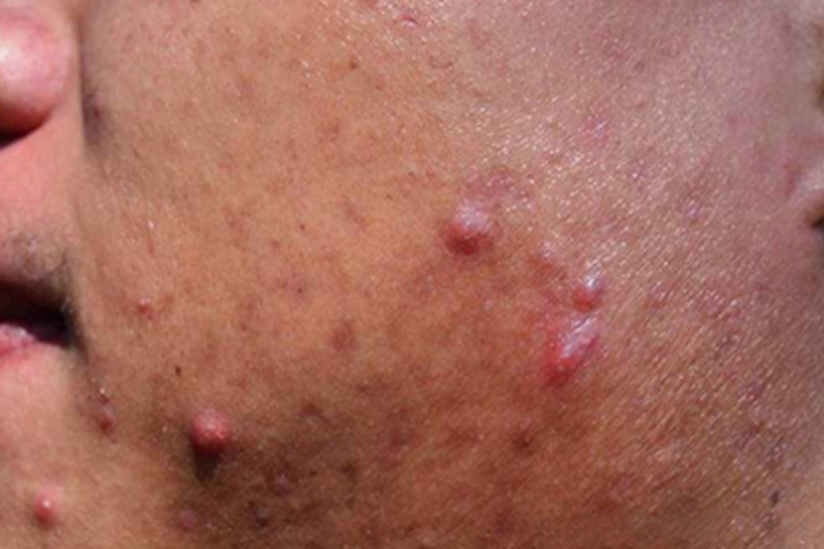 老年人脸上中重度痤疮图