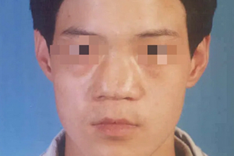 鼻裂鼻部症状图 鼻裂鼻部症状图