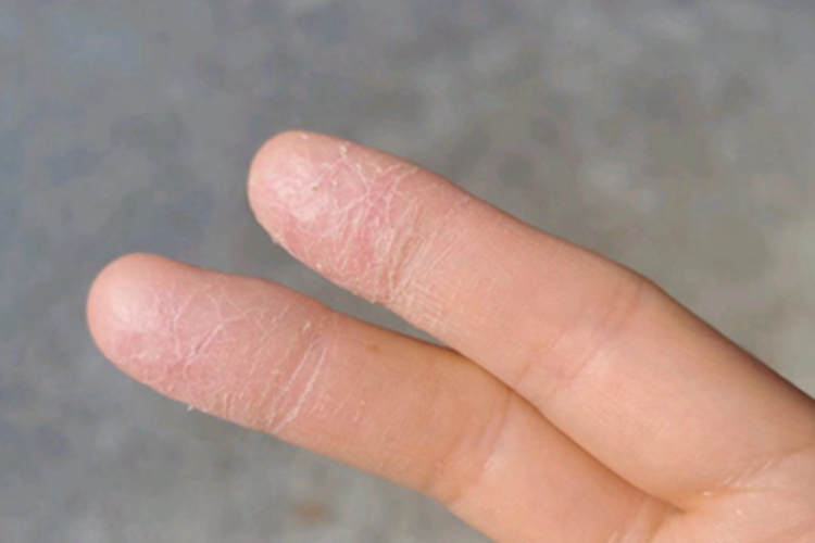 手部湿疹手指尖皮肤粗糙图