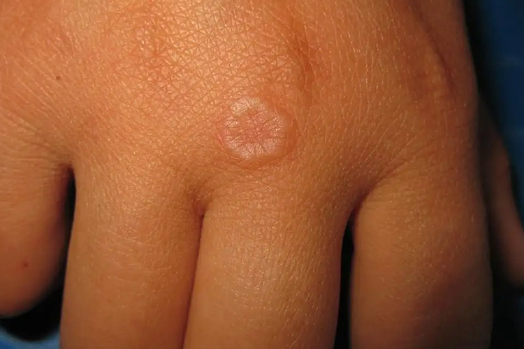 环状排列性丘疹图