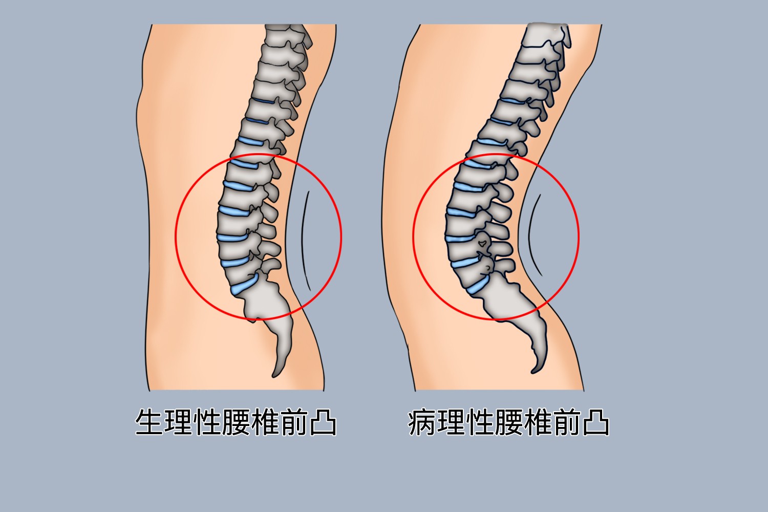 腰椎前凸图