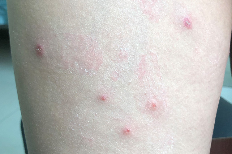 手背、胳膊的被侧及小腿任意部位红色丘疹图 手背、胳膊的被侧及小腿任意部位红色丘疹图