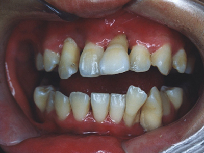 广泛型侵袭性牙周炎牙龈萎缩牙齿不齐图.jpg