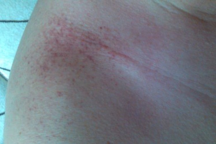 肩膀轻度红色痧图