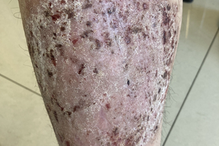 慢性湿疹小腿结痂图 慢性湿疹小腿结痂图