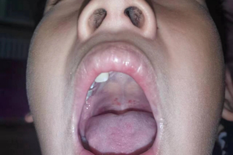 疱疹性口炎口腔红点图