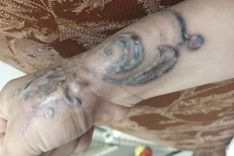 洗纹身疤痕增生图