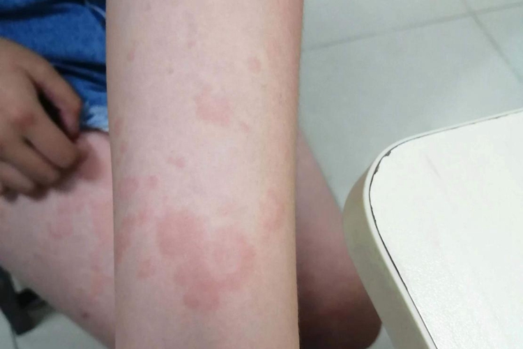 打疫苗后皮疹图