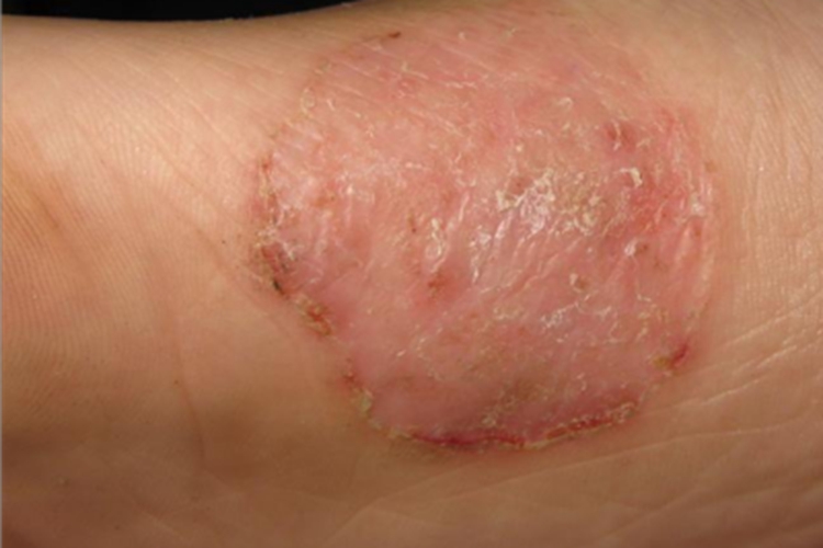 湿疹样型癣菌疹症状图