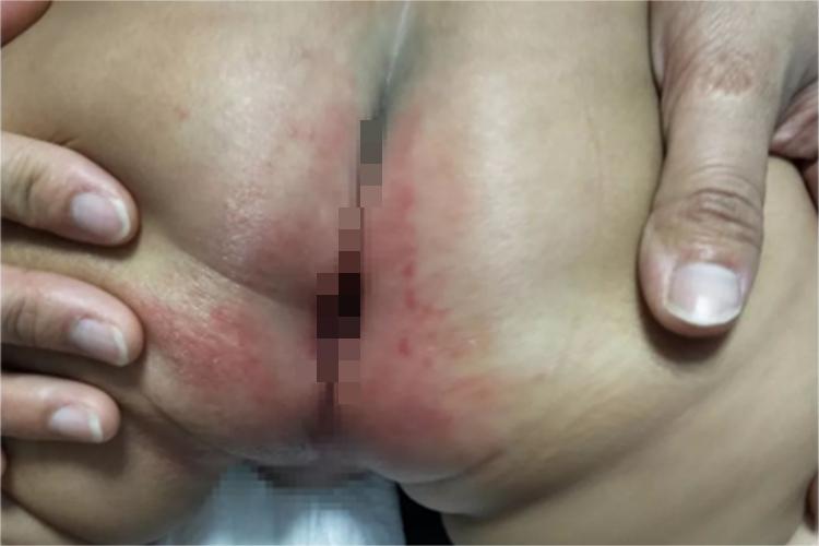 婴儿尿布疹臀部小红疙瘩图