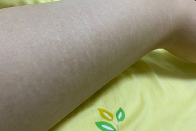 萎缩纹小腿条纹图