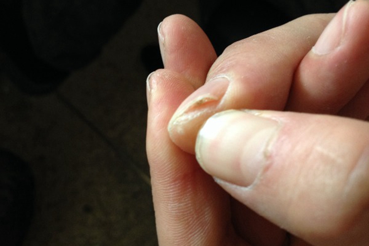 手指甲缝长肉芽甲胬肉图