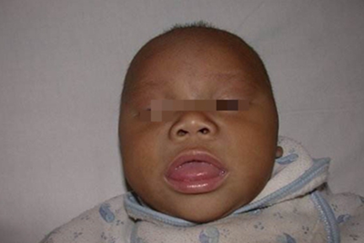 地方性克汀病头部变形图