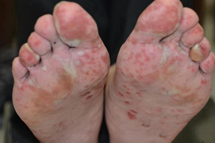 男性三期梅毒脚底脓包图