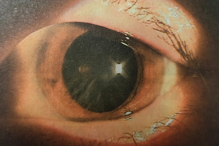 核性白内障眼球黑色图