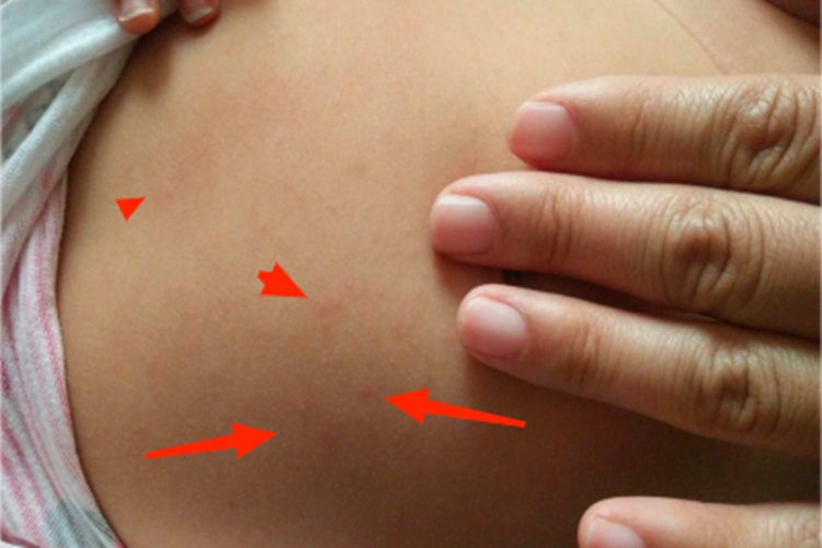 幼儿急疹肚子有小红点图