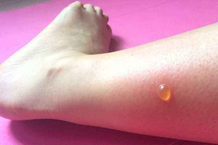 毒蚊子咬后症状图