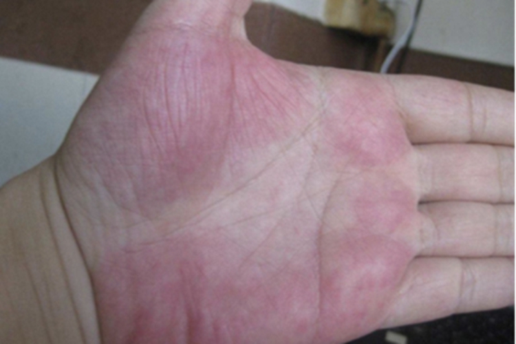 肝硬化手掌大范围充血图