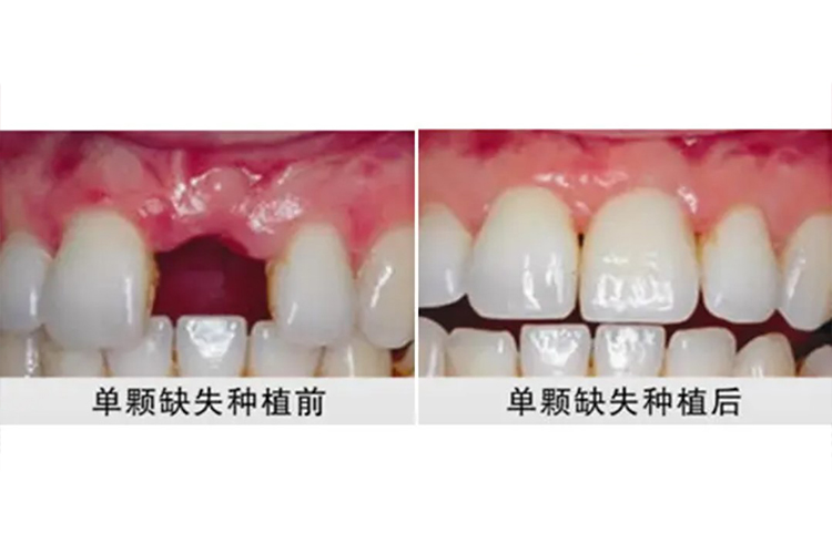 单颗上牙种植牙效果图 单颗上牙种植牙效果图