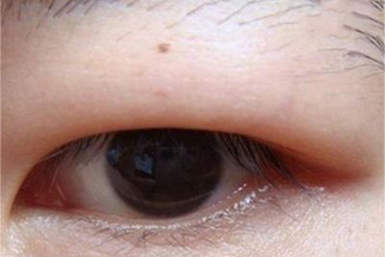 泪腺脱垂上眼睑肿了图