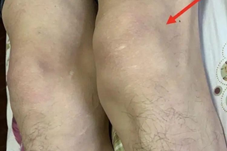 肥大性骨关节病膝关节肿大图 肥大性骨关节病膝关节肿大图