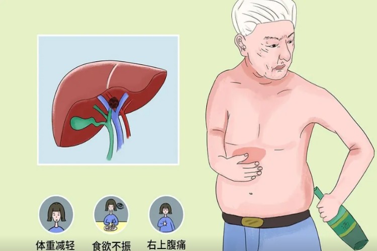 肝肿大早期症状图 肝肿大早期症状图