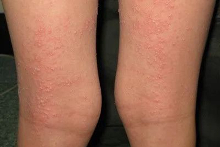 乙型肝炎抗原血症大腿症状图 乙型肝炎抗原血症大腿症状图