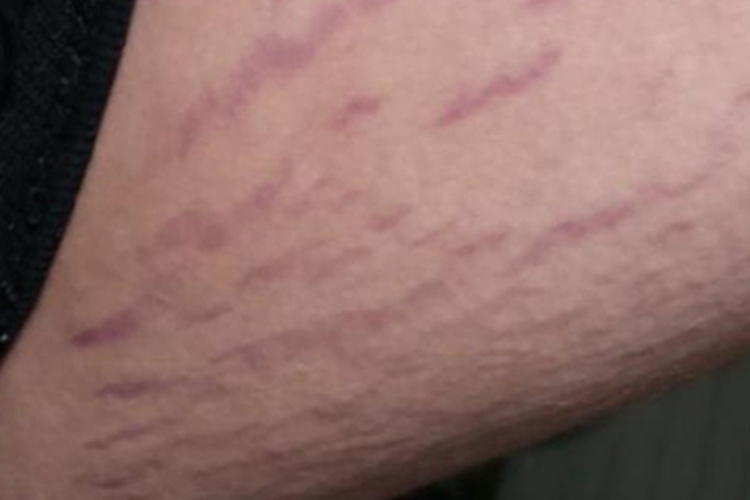 妊娠纹大腿纹图 妊娠纹大腿纹图