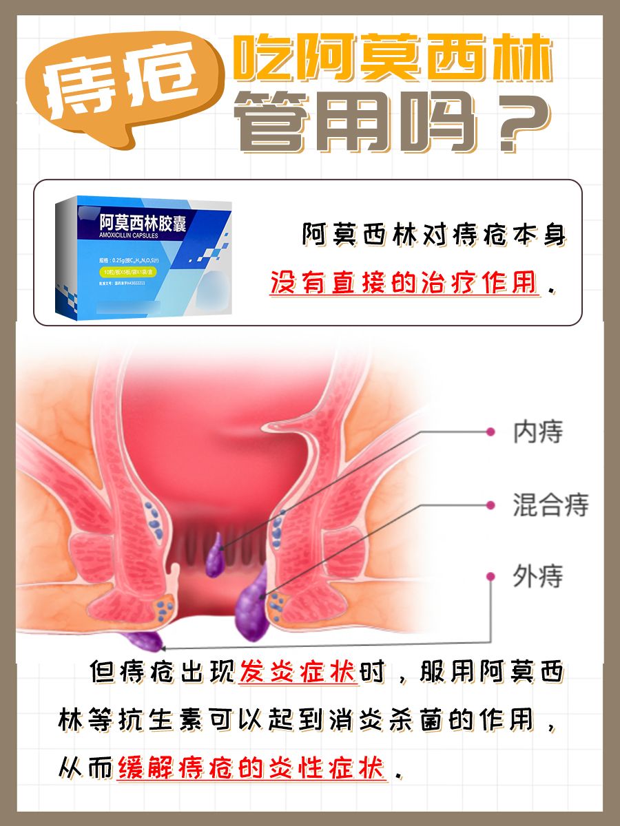 痔疮来袭，阿莫西林能否成为“救星”？