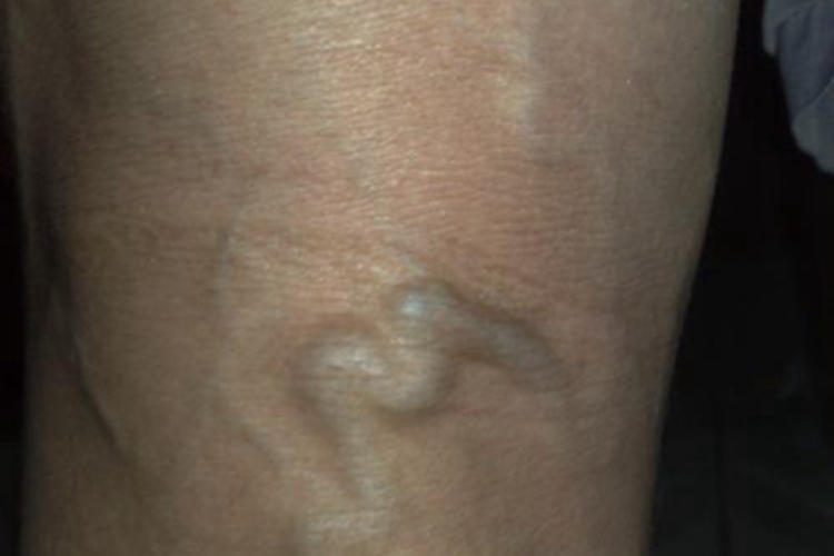 游走性血栓性静脉炎腿部症状图