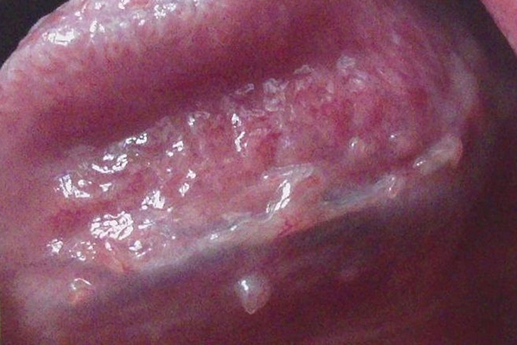 口腔无柄型尖锐湿疣图