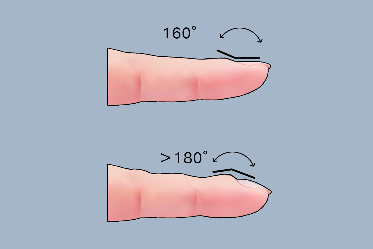 轻度杵状指自测图