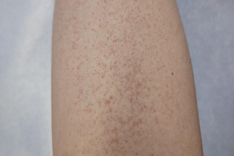 特发性血小板减少性紫癜红点图 特发性血小板减少性紫癜红点图