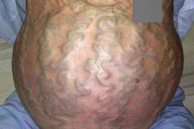 海蛇头样静脉曲张图 海蛇头样静脉曲张图