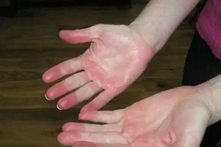 红斑性肢痛症手部症状图