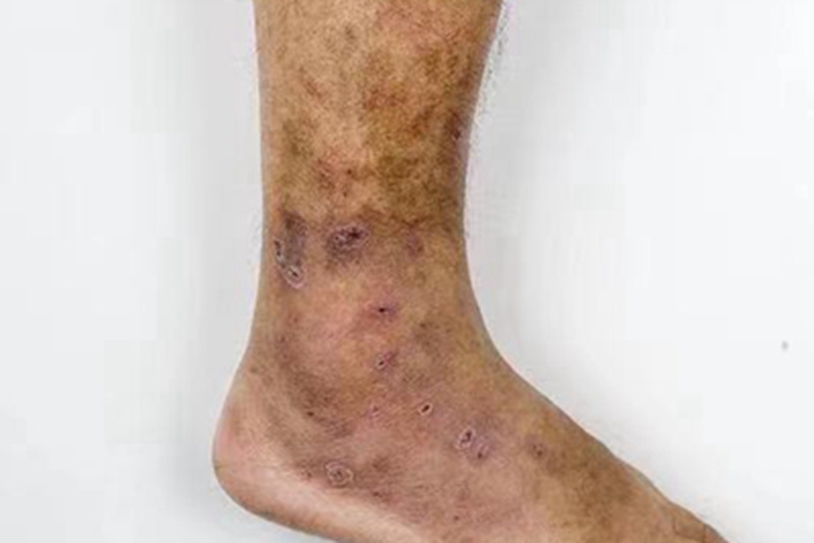 色素性紫癜性皮疹结痂图