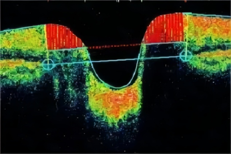 正常视盘结构图