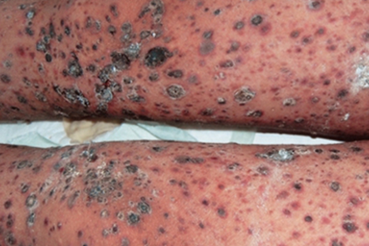 苔藓样糠疹大腿结痂图