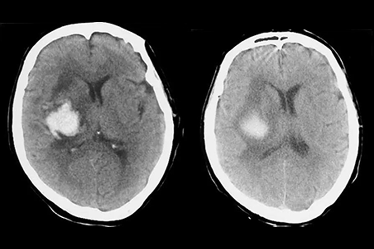 高血压病内囊出血CT图 高血压病内囊出血CT图