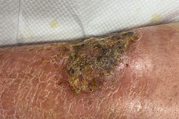 急性湿疹腿结痂图 急性湿疹腿结痂图