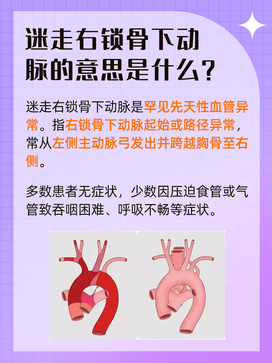 健康奥秘：迷走右锁骨下动脉是什么意思？