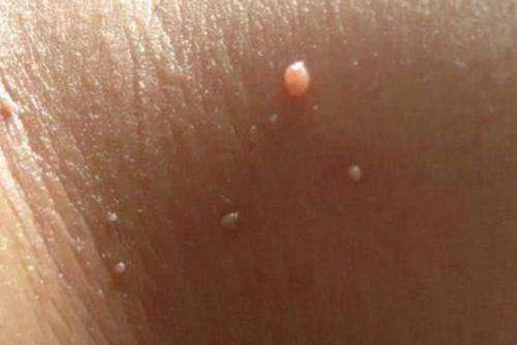 小孩腋下寻常疣图