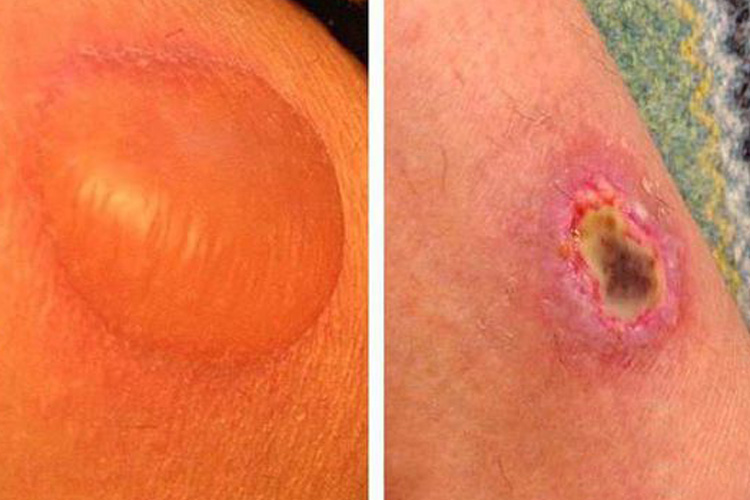 棕蛛中毒所致水肿伴大疱图