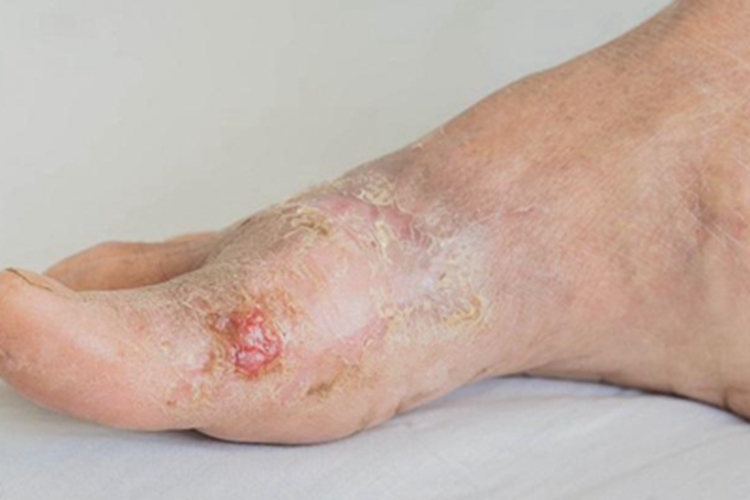 人工性脂膜炎脚部糜烂有黄痂图