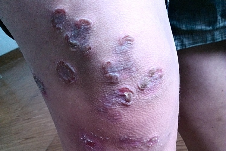 疱疹样脓疱病大腿溃疡图
