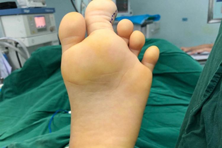 巨指畸形脚趾异常粗大图