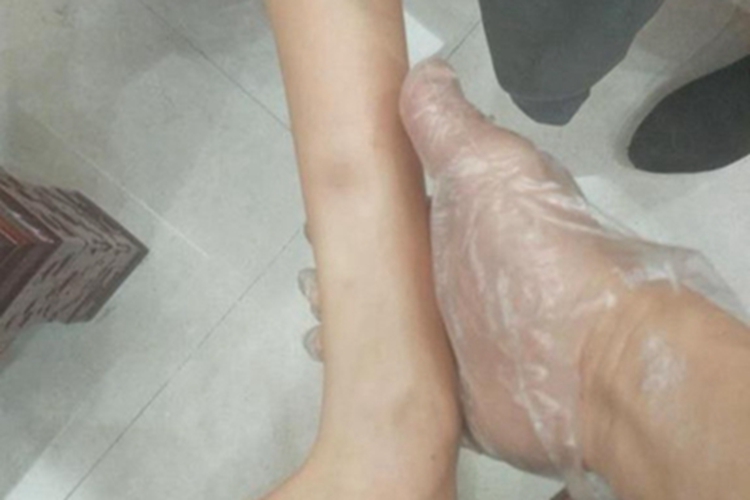 先天性多发性关节挛缩症踝弯曲图