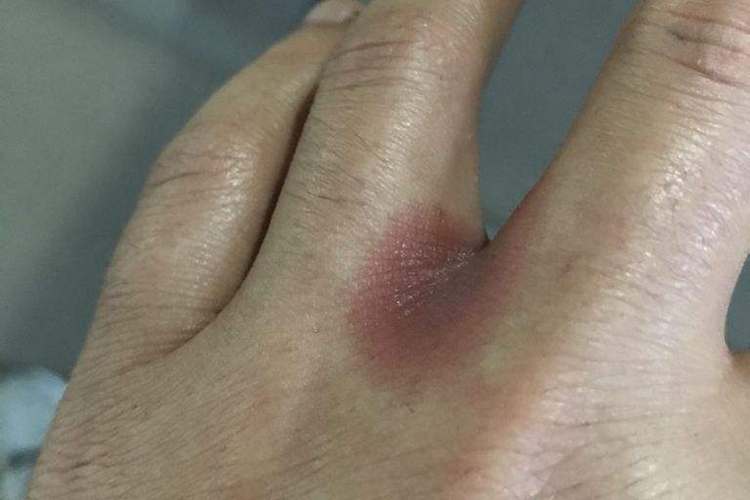 接触性皮炎手指缝发红图